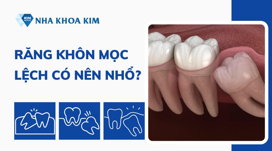 Răng khôn mọc lệch có nên nhổ không?
