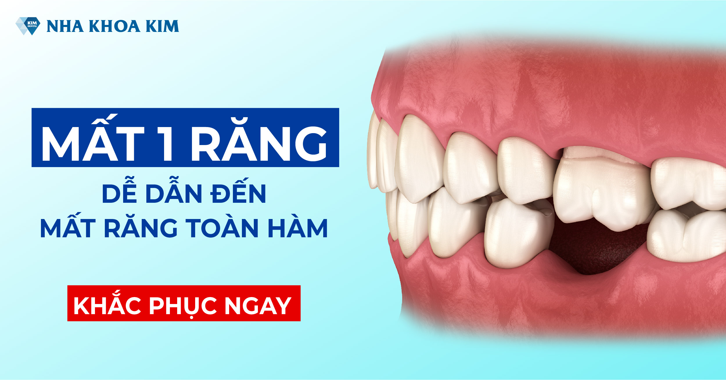 Mất 1 Răng Dễ Dẫn Đến Mất Răng Toàn Hàm, Khắc Phục Ngay Mất 1 Răng Dễ Dẫn Đến Mất Răng Toàn Hàm, Khắc Phục Ngay