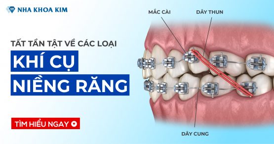 Tất tần tật về các loại khí cụ niềng răng