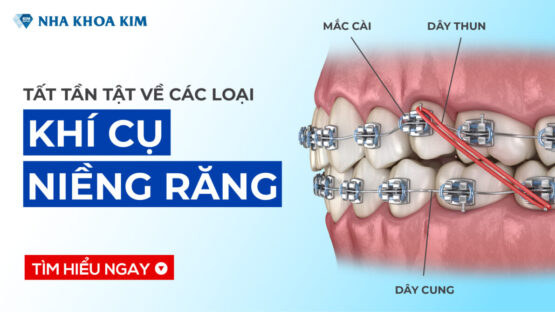 Tất tần tật về các loại khí cụ niềng răng