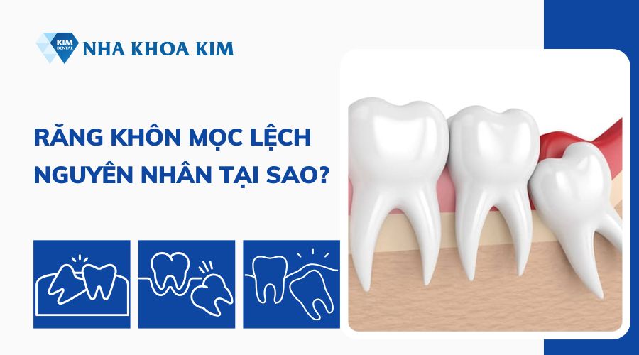 Vì sao răng khôn mọc lệch?