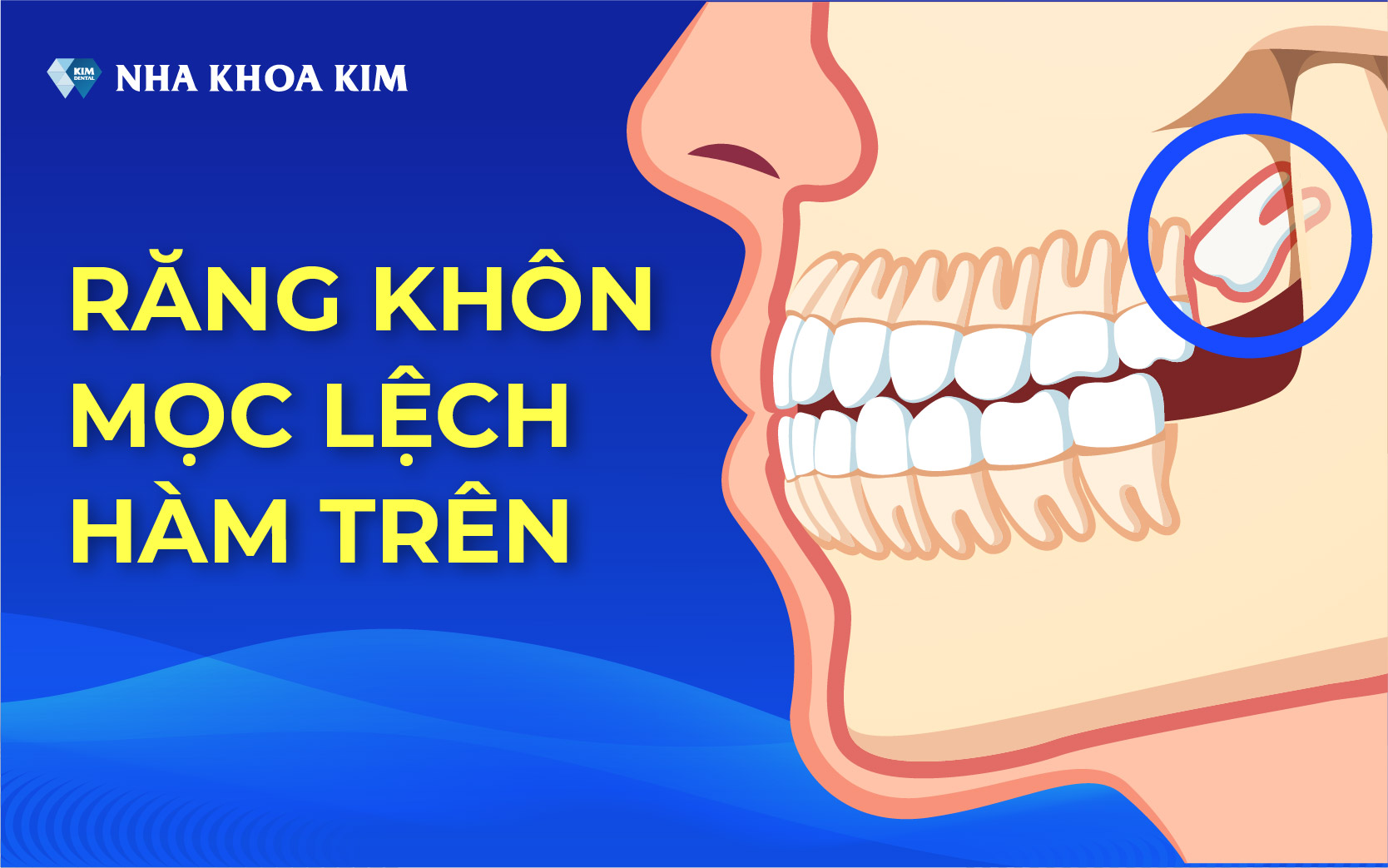 Răng số 8 mọc lệch tác động lên các răng khác gây ra đau nhức