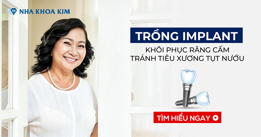 Trồng Implant Khôi Phục Răng Cấm, Tránh Tiêu Xương Tụt Nướu Trồng Implant Khôi Phục Răng Cấm, Tránh Tiêu Xương Tụt Nướu