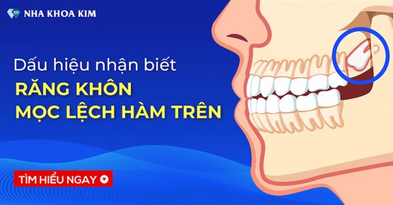 Dấu hiệu nhận biết răng khôn mọc lệch hàm trên và giải pháp khắc phục