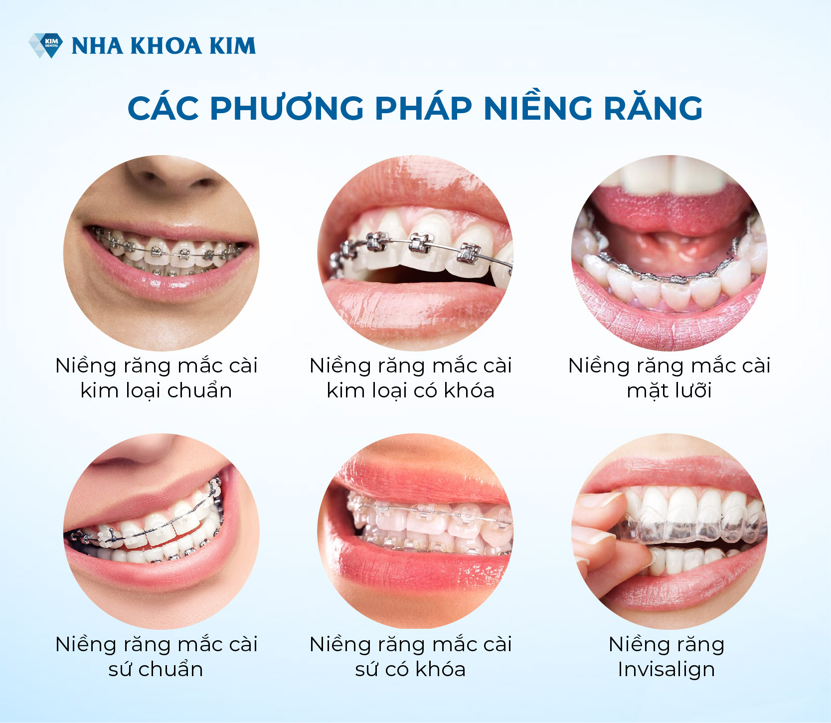 Các phương pháp nắn chỉnh răng tại Nha khoa Kim