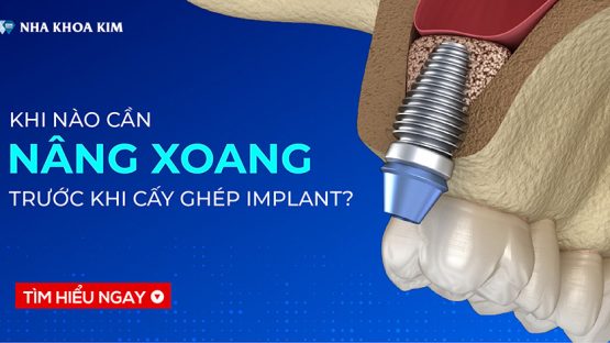 Nâng xoang là gì? Khi nào cần nâng xoang trước khi cấy ghép Implant?