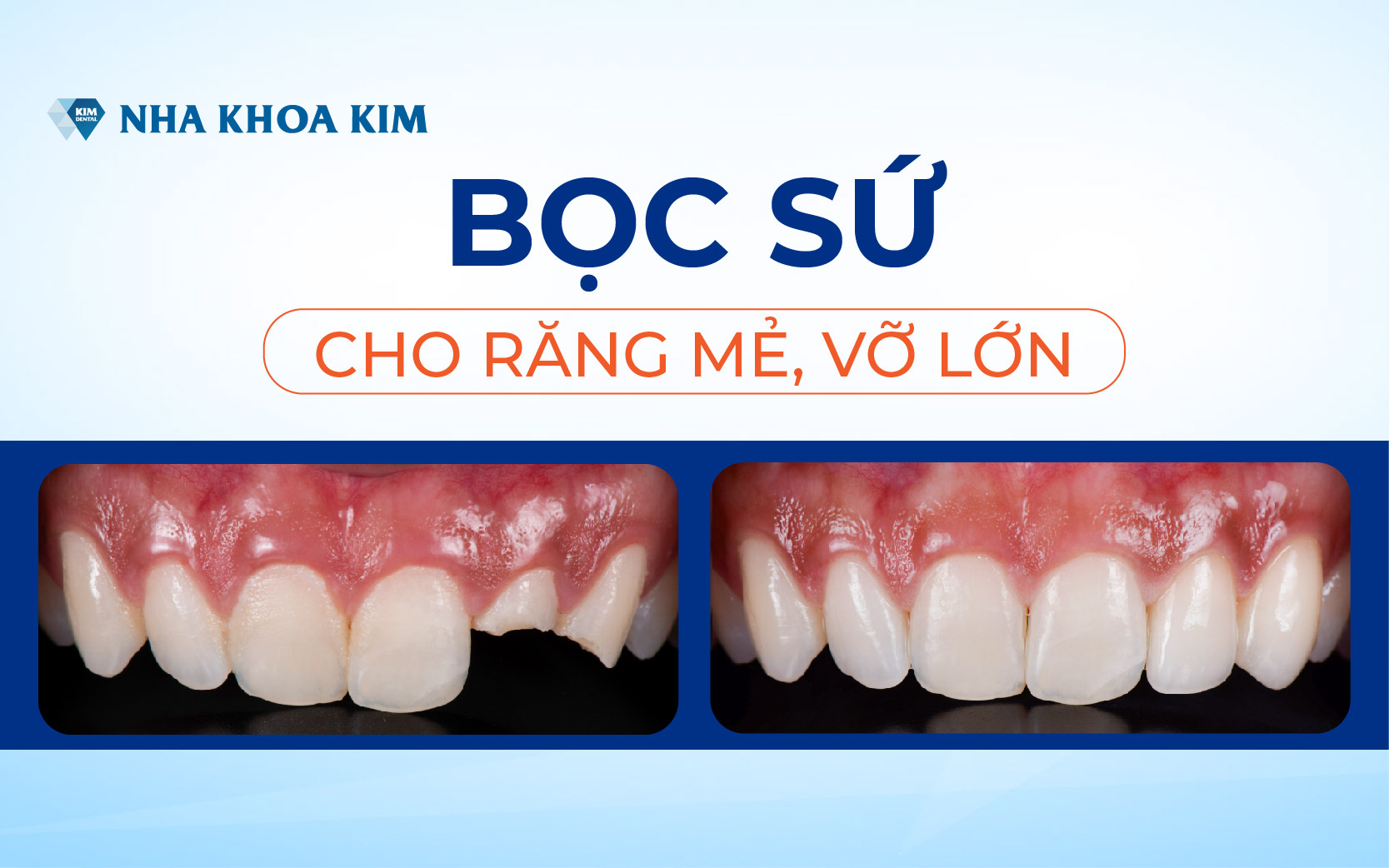 Bọc sứ cho răng mẻ, vỡ lớn Bọc sứ cho răng mẻ, vỡ lớn