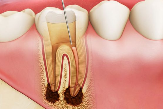 Dịch vụ điều trị tủy bị sưng tại Nha Khoa Kim an toàn, chất lượng