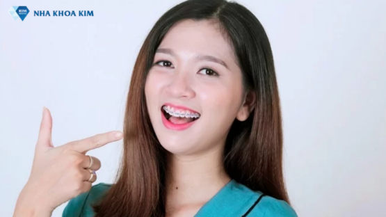 Niềng Răng Không Mắc Cài Giá Bao Nhiêu Tiền?