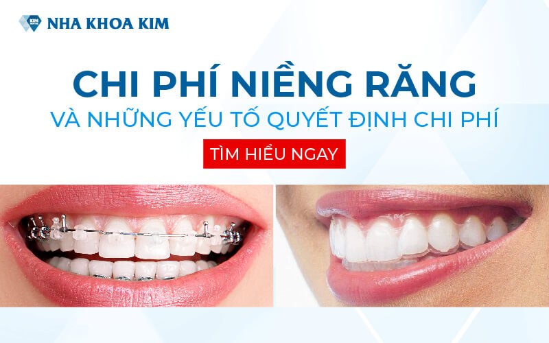 Chi phí niềng răng và những yếu tố quyết định chi phí Chi phí niềng răng và những yếu tố quyết định chi phí