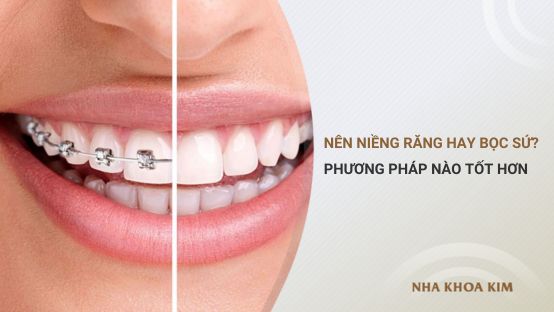 Nên niềng răng hay bọc răng sứ? Phương pháp nào tốt hơn?