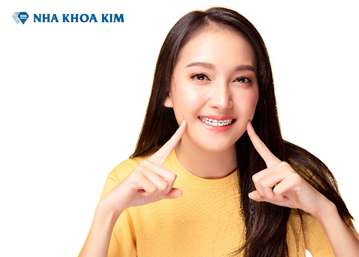 răng hô nên niềng răng hay bọc răng sứ - Nha Khoa Kim