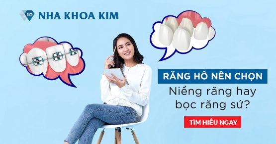 Răng hô nên chọn niềng răng hay bọc răng sứ?