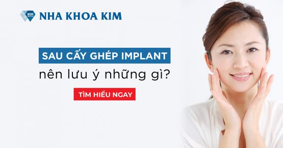 Sau cấy ghép Implant nên lưu ý những việc gì?