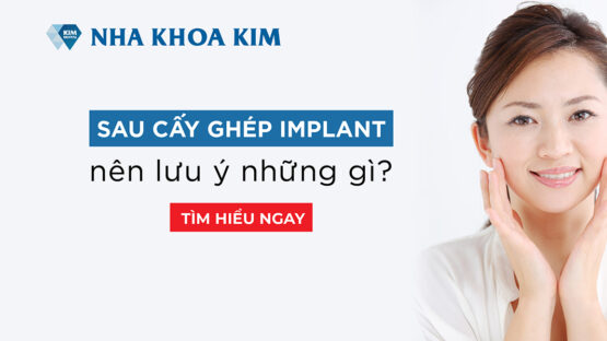 Sau cấy ghép Implant nên lưu ý những việc gì?