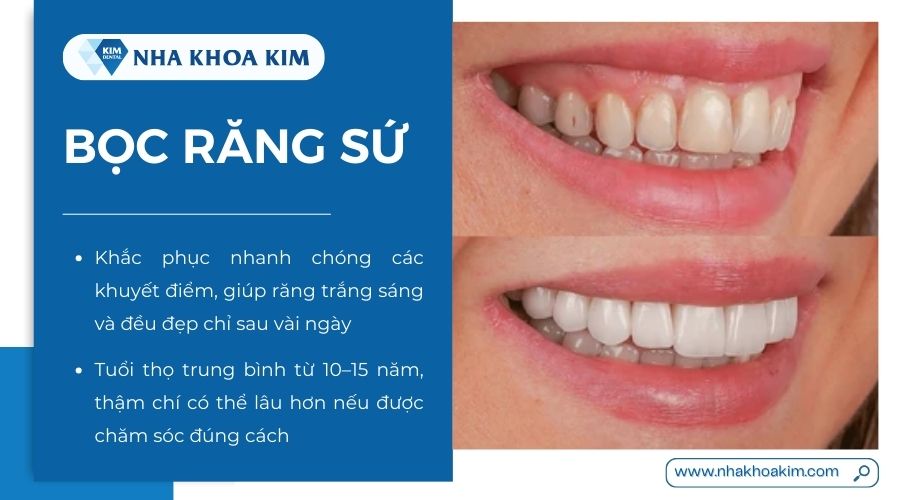 Ưu nhược điểm bọc răng sứ 