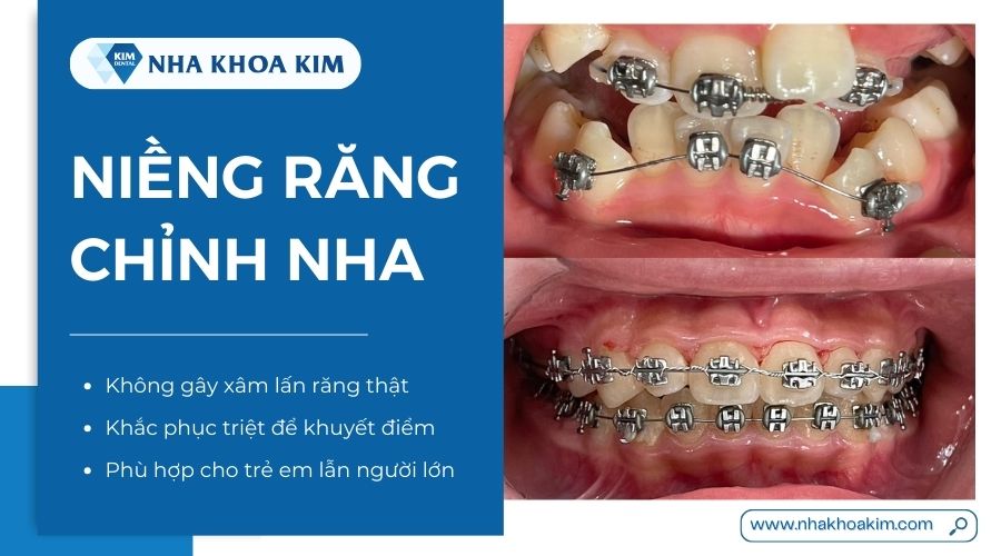 ưu nhược điểm của niềng răng chỉnh nha