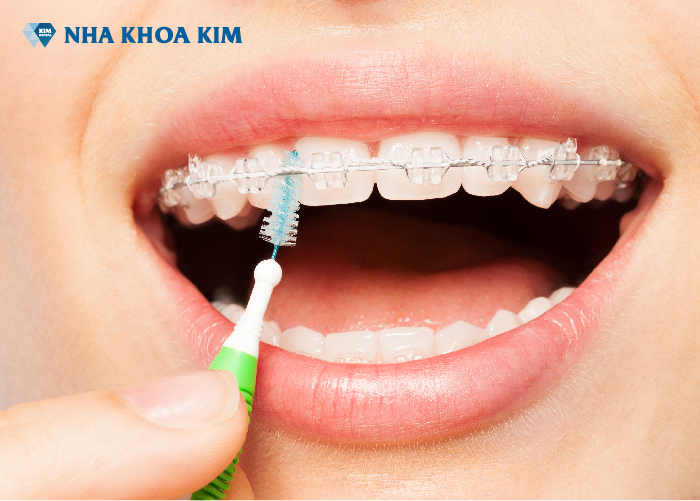 chăm sóc răng niềng Nha Khoa Kim