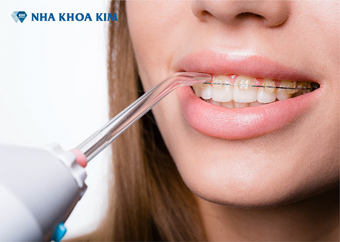 Nha khoa KIM sử dụng vật liệu niềng răng cao cấp