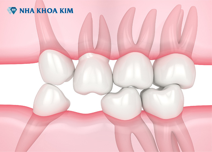 Mất răng có niềng răng được không - Nha Khoa Kim