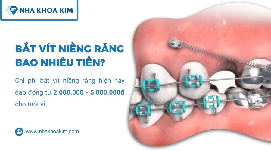 bắt vít niềng răng bao nhiêu tiền