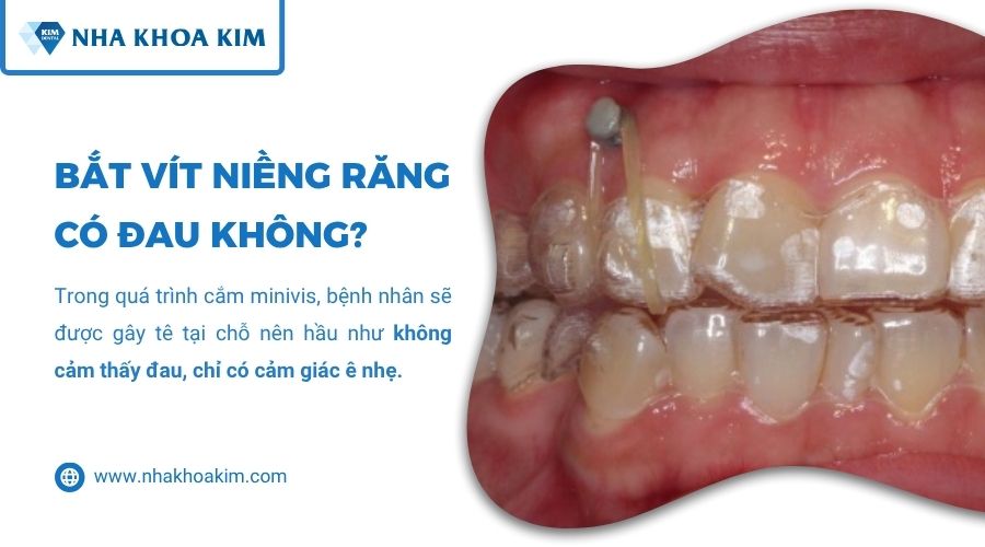 Bắt vít niềng răng có đau không
