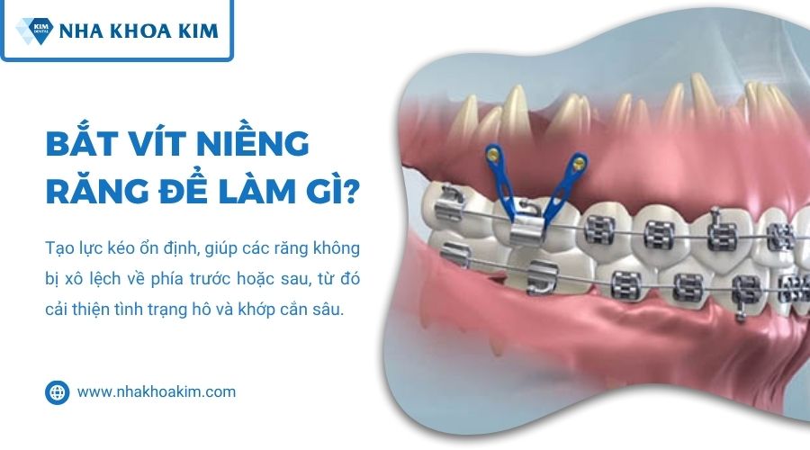 bắt vít niềng để làm gì