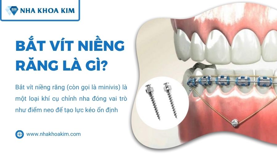 bắt vít niềng răng là gì