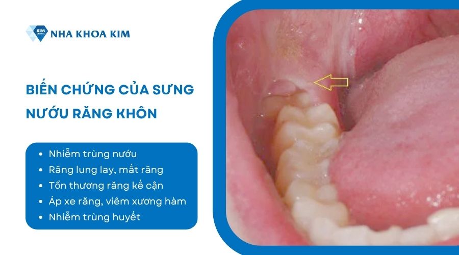 sưng lợi răng khôn có nguy hiểm không