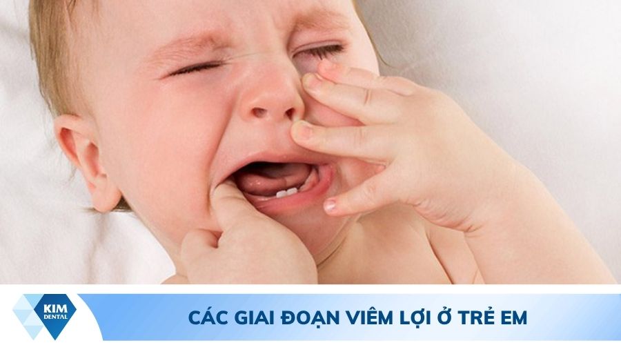 các giai đoạn viêm lợi ở trẻ