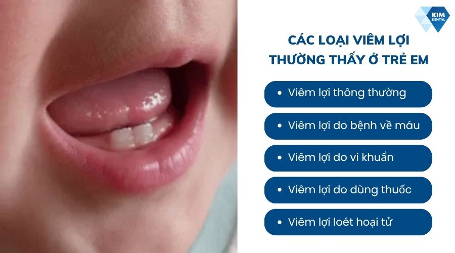 các loại viêm nướu thường thấy ở trẻ em