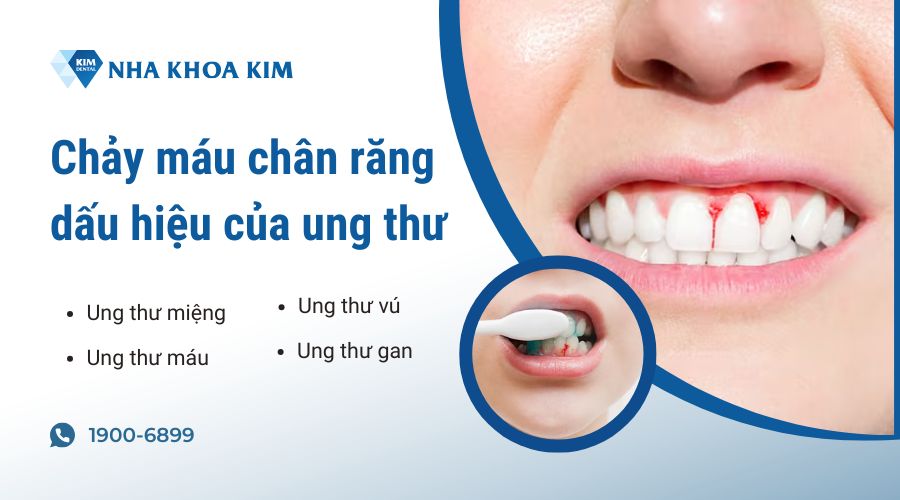 chảy máu chân răng dấu hiệu ung thư