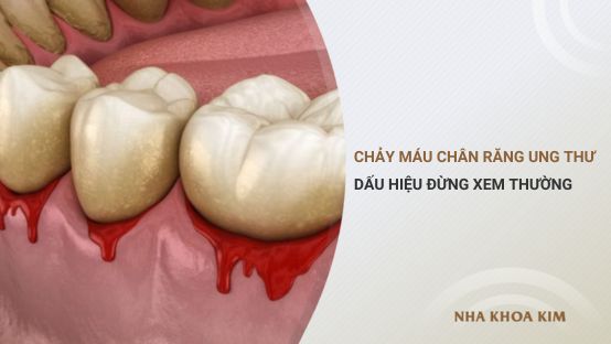 Chảy máu chân răng ung thư – Dấu hiệu đừng nên xem thường