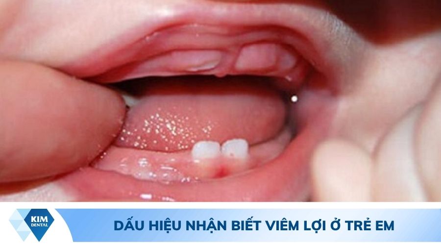 dấu hiệu nhận biết viêm lợi ở trẻ em