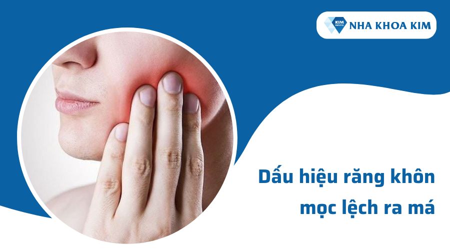 Dấu hiệu răng số khôn mọc lệch ra má