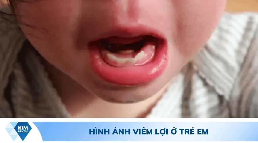 Hình ảnh trẻ bị viêm lợi và sốt