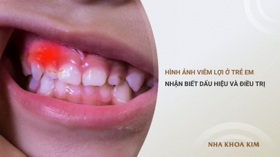 Hình ảnh viêm lợi ở trẻ em giúp nhận biết dấu hiệu và điều trị