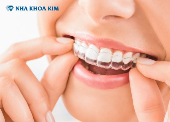 Niềng răng lần 2 có ảnh hưởng tới sức khỏe không?