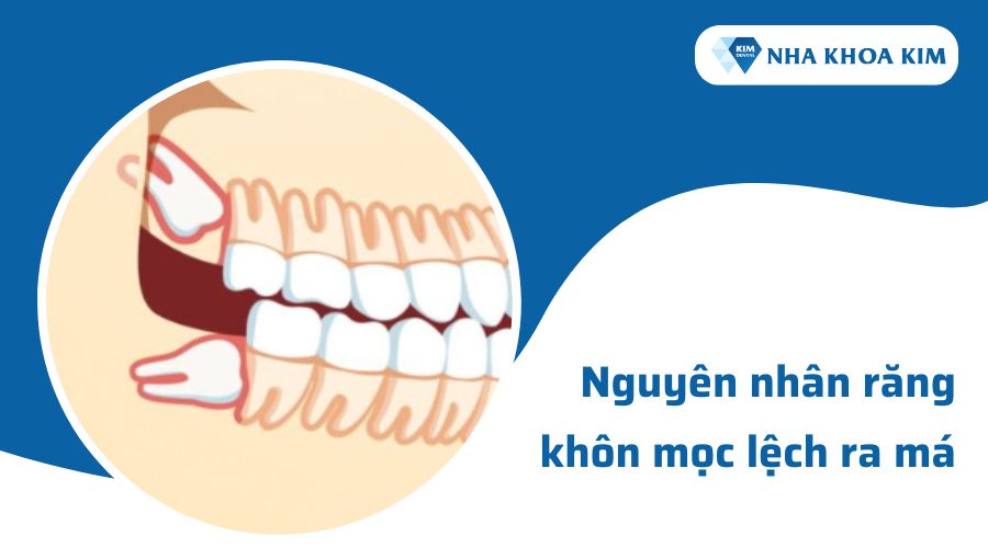 Nguyên nhân răng khôn mọc lệch ra má