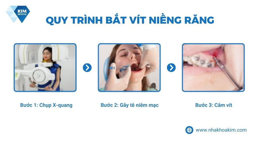 quy trình bắt vít niềng răng