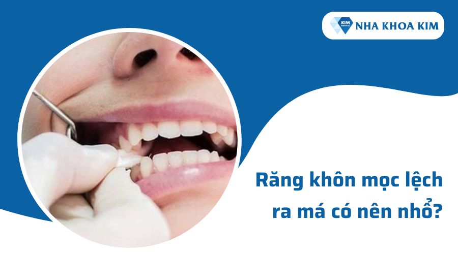 Răng khôn mọc lệch ra má có nên nhổ không?