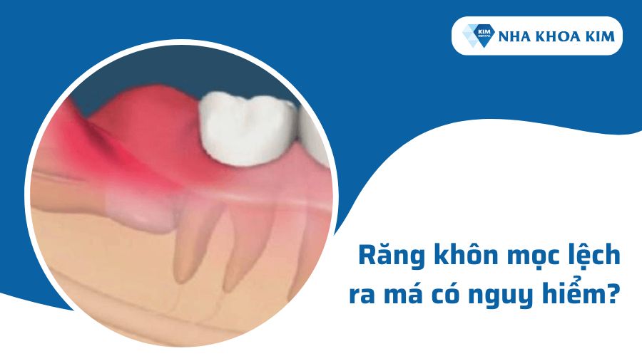 Răng khôn mọc lệch ra má có nguy hiểm không?