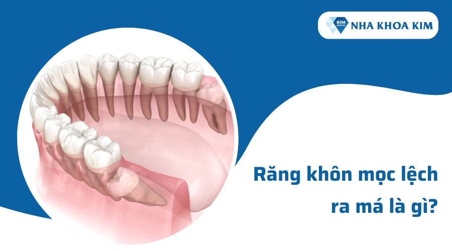 Răng khôn mọc lệch ra má là gì?