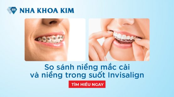 So sánh niềng răng mắc cài và niềng răng trong suốt invisalign