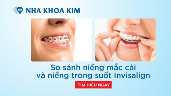 So sánh niềng răng mắc cài và niềng răng trong suốt invisalign