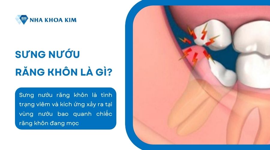 sưng nướu răng khôn là gì