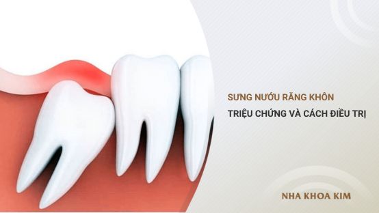 Nguyên nhân gây sưng nướu răng khôn và cách điều trị
