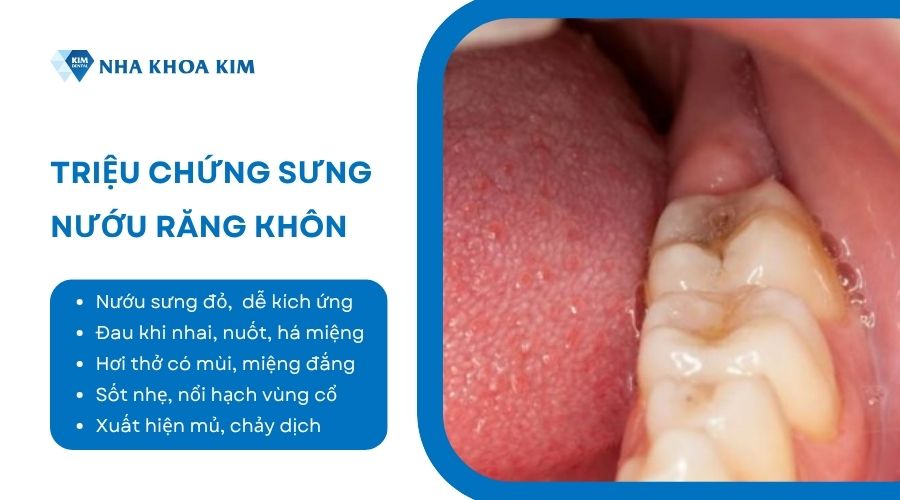 triệu chứng sưng nướu răng khôn