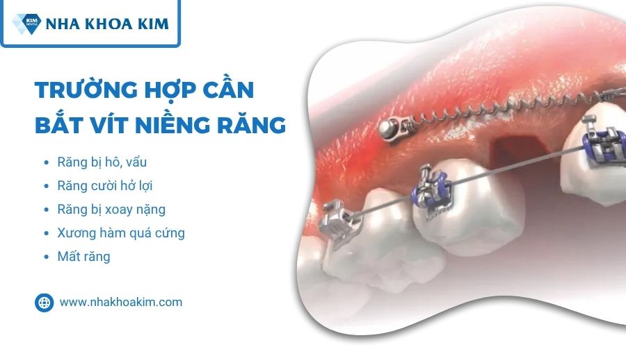 khi nào cần bắt vít niềng răng