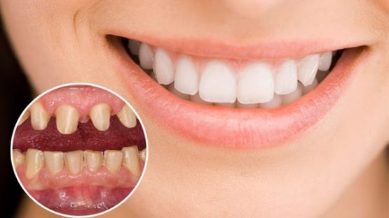 3 loại bảng màu răng sứ Vita phổ biến nhất hiện nay